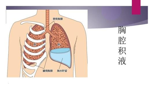 如何有效预防胸腔积液